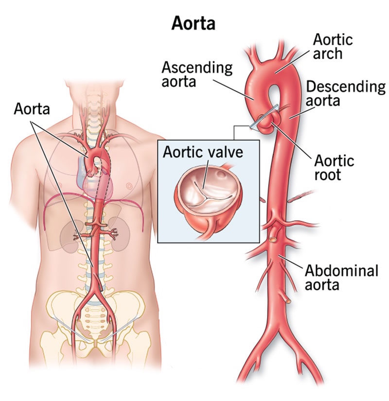Aortic condition illustration